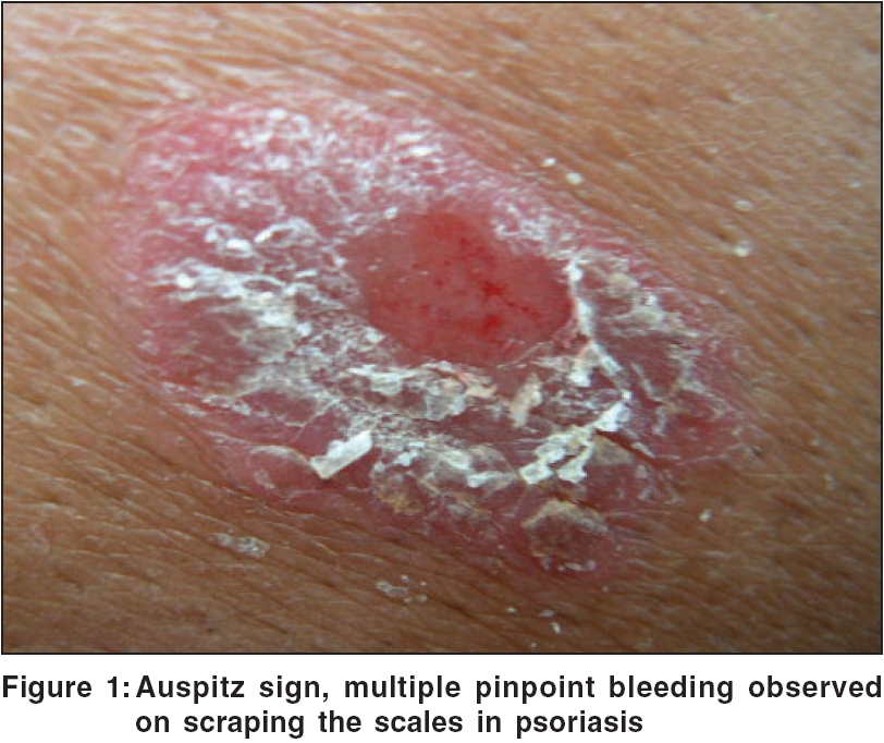 psoriasis scale