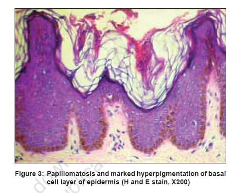 mild epidermal papillomatosis