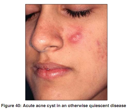 Intralesional corticosteroids acne